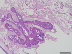 Epitélio escamoso não queratinizado mostra desenvolvimento invertido. Inúmeras células mucíparas no epitélio e epitélio adjacente à metaplasia óssea, contendo medula óssea (H&E, aumento original ×40).