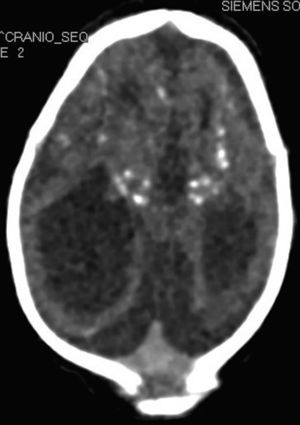 Tomografia encefálica axial. Observe a atrofia cerebral e calcificações.