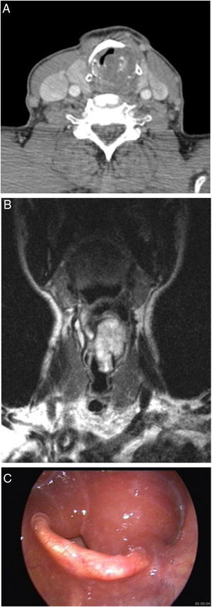 (A ‐ C) homem de 70 anos com condroma laríngeo. Imagem de TC realçada por contraste (A) mostra a massa expansiva que surge da cartilagem cricoide. Calcificações condroides são vistas dentro da massa. A imagem coronal TSE ponderada em T2 (B) mostra massa transglótica com alta intensidade de sinal. A endoscopia (C) revela edema bilateral da mucosa das cartilagens aritenoides e uma grande massa submucosa.