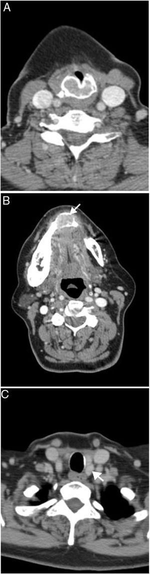 (A ‐ C) mulher de 52 anos com hiperparatireoidismo primário e múltiplos tumores marrons. A imagem de TC realçada por contraste (A) mostra um tumor marrom expansivo que surge da cartilagem cricoide. A massa expansiva lítica mandibular é vista em imagens de TC superiores (B). O adenoma da paratireoide é visto na glândula paratireoide inferior esquerda (C).