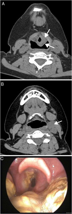 (A‐C) Mulher de 23 anos com doença linfoproliferativa pós‐transplante, monomórfica, tipo difusa de grandes células B. TC sem realce mostra massa (setas) (A) na prega ariepiglótica esquerda e linfadenopatia cervical esquerda (seta) (B). Imagem endoscópica (C) revela massa amarelada irregular que envolve a banda ventricular esquerda, prega ariepiglótica e base da língua.