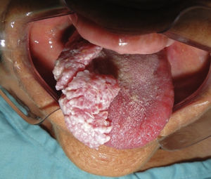 Aspecto verrucoso da lesão em região do dorso e bordo lateral de língua.
