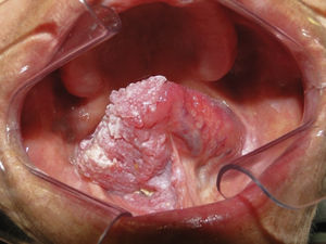 Envolvimento da lesão no ventre de língua e parte do assoalho bucal.