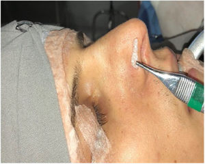 Alar rim graft confeccionado com cartilagem septal. Local onde será inserido o enxerto.