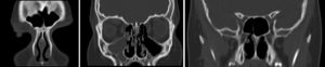 Tomografia computadorizada dos seios paranasais (pós‐operatório) mostra apenas opacidade do seio maxilar direito.