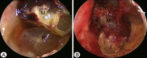 Achados endoscópicos intraoperatórios pela abordagem de Caldwell‐Luc. (A) A mucosa polipoide (P) foi detectada na porção inferior do seio maxilar esquerdo. (B) Após a remoção da mucosa polipoide, a massa altamente vascular (M) se originava a partir da parede superior medial e parcial do seio maxilar esquerdo.