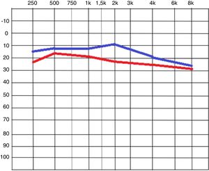 Imagem da audiometria tonal, compara em vermelho as médias dos valores iniciais e em azul após a colocação da película.