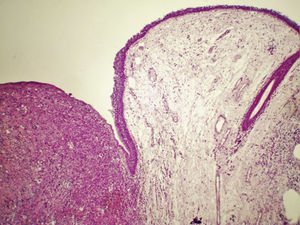 Sarcoma pleomórfico indiferenciado de alto grau com origem na laringe: sarcoma pleomórfico de alto grau que afeta a lâmina própria, circunda a área de edema, hematoxilina‐eosina, 40×.