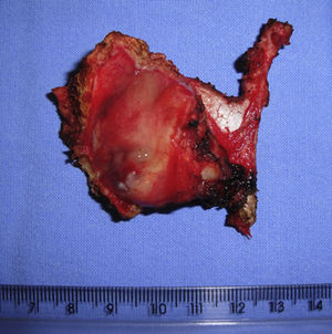 Sarcoma pleomórfico indiferenciado de alto grau com origem na laringe: amostra obtida de laringectomia frontolateral direita.