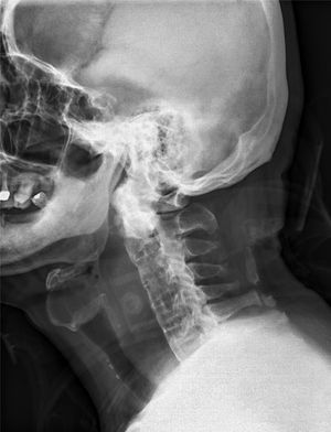 Radiografia lateral da coluna cervical mostra alargamento do espaço retrofaríngeo (> 7mm no nível C3).