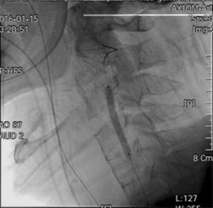 Angiografia mostra a implantação do stent na artéria vertebral direita.