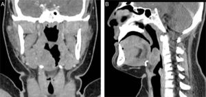 Tomografia computadorizada coronal (A) e sagital (B), com meio de contraste, mostra uma lesão tumoral no lado direito da base da língua. Nenhuma linfadenopatia no pescoço foi evidenciada.