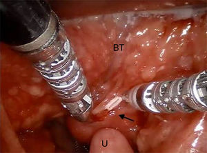 Vista intraoperatória de campo cirúrgico. Excelente exposição para visualização do tumor (seta), base da língua (BT) dorsal e medial e úvula (U).