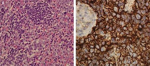 (A) A lesão consistia em lâminas difusas de pequenas células redondas azuis com citoplasma escasso e nucléolos discretos (hematoxilina‐eosina, ampliação original×20); (B) A imuno‐histoquímica para CD99 demonstrou coloração membranosa difusa de células tumorais (×40).