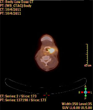 Imagem de PET‐TC mostra envolvimento hipermetabólico denso na laringe. Surgimento de recorrência locorregional após laringectomia parcial.