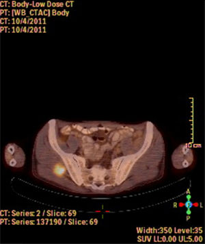 Metástase de CEC laríngeo para o músculo glúteo médio. Imagem de PET‐TC mostra um acúmulo denso de FDG no glúteo médio direito.