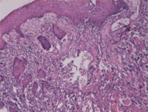 CEC laríngeo. Imagens de cortes da laringe mostram epitélio escamoso estratificado na superfície. Estrutura tumoral mostra infiltração profunda a partir da camada epitelial. Tumor estruturado por células atípicas forma ilhas sólidas, apresenta pleomorfismo. Células tumorais com núcleos vesiculares, nucléolos pleomórficos e um grande citoplasma eosinofílico. Hematoxilina e eosina (H/E) ×100.
