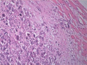 Metástase de CEC laríngeo para o músculo glúteo médio. Células tumorais infiltram células do músculo estriado (à direita). H/E × 200.