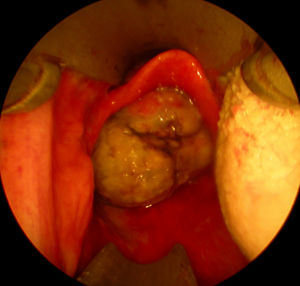 Visualização endoscópica da lesão laríngea via diverticuloscópio de Weerda com o paciente em posição supina. A epiglote parece completamente normal acima da lesão tumoral intralaríngea.