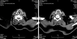 TC axial no nível das cartilagens tireoide (esquerda) e cricoide (direita) com obstrução completa do lúmen e sem evidência de invasão da cartilagem. O paciente respira através de uma traqueostomia.