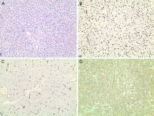 Imagens histológicas do HPC com diferentes colorações: (a) hematoxilina‐eosina; (B) coloração imuno‐histoquímica para Ki‐67; (C) coloração imuno‐histoquímica para CD34; (D) coloração imuno‐histoquímica para CD99.