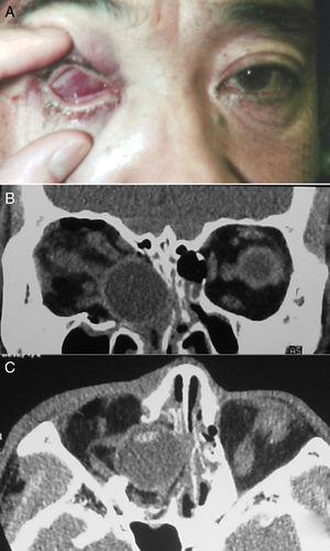 A, Aparência do olho direito na apresentação inicial. B‐C, Fraturas do assoalho orbitário e da parede medial do globo ocular deslocado foram identificados na tomografia computadorizada.