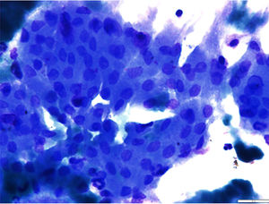 Aspiração com agulha fina da lesão da glândula parótida mostra epitélio oncocítico agrupado, em favo de mel, cercado por alguns linfócitos. As células epiteliais possuem núcleos redondos uniformes e citoplasma moderado finamente granular (coloração de Papanicolaou, ×400).