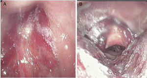 Hemorragia submucosa extensa. (A) Nasofaringe; (B) laringe e hipofaringe.