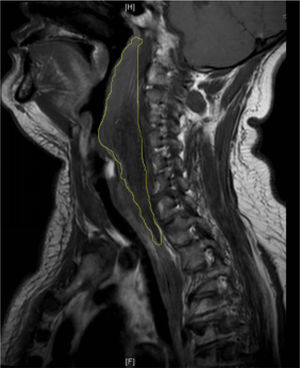 As imagens de ressonância magnética sagital revelaram um sinal irregular anormal estendendo‐se da segunda vértebra cervical até o mediastino posterior.