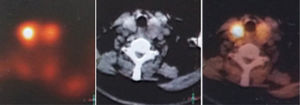 Exames de tomografia computadorizada de emissão de fóton único revelaram um adenoma de glândula paratireoide esquerda.