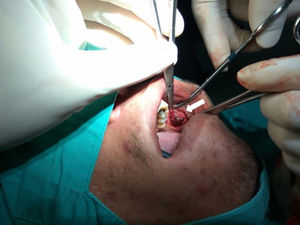 Excisão intraoral da intumescência oral esquerda (seta).
