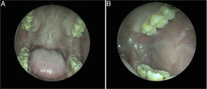 Em A, a cavidade oral um mês após a excisão; em B, a mucosa oral esquerda um mês após a excisão.