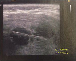 Imagem linear hiperdensa no interior do lóbulo esquerdo da tireoide, com conteúdo associado a detritos.