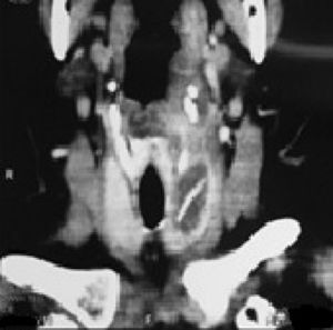 TC mostra uma coleção justaposta no lóbulo esquerdo da tireoide com um corpo estranho no interior.