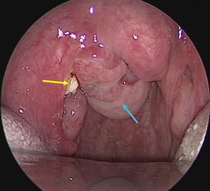 Um tumor lobulado era, na verdade, um enorme peritonsilólito direito encapsulado (seta azul) que se estendia para o espaço peritonsilar direito e um pequeno tonsilólito amarelado (seta amarela) no polo superior da tonsila palatina direita.