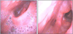 Fibrolaringoscopia na admissão. Epiglote e mucosa aritenoide esquerda se encontram edematosas.