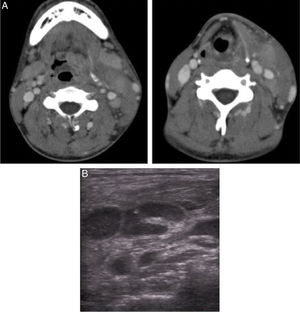 Exame ultrassonográfico e tomografia computadorizada cervical com contraste (A, B). (A) O exame ultrassonográfico mostra edema dos linfonodos cervicais. (B) Tomografia computadorizada com contraste mostra edema dos linfonodos cervicais, de tecido mole e do músculo esternocleidomastóideo.