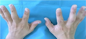 Descamação das pontas dos dedos.