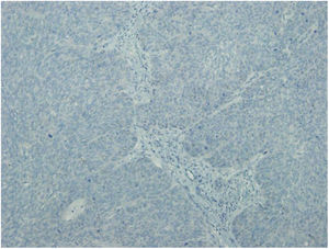 Carcinoma espinocelular não metastático; coloração para CSE1L negativa.
