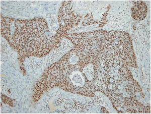 Carcinoma espinocelular metastático; coloração nuclear para CSE1L positiva.