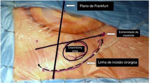 Diferenças na dimensão de uma craniotomia feita com abordagem tradicional retrosigmoide e com a EAMIRSA.