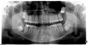 Radiografia panorâmica mostra área cística ao redor dos dentes não irrompidos em três quadrantes.