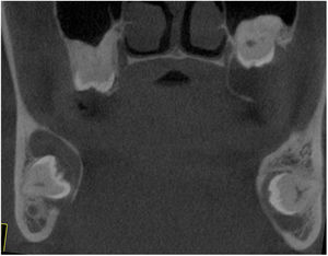Imagem de TCFC coronal mostra lesão cística expansiva em torno das coroas de molares impactados na maxila e mandíbula.