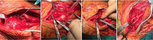 (A) Embolização com molas intraoperatória. (B) Paciente Shamblin Tipo III – Invasão da carótida. (C) Divisão da artéria carótida externa. (D) Reanastomose da carótida externa.
