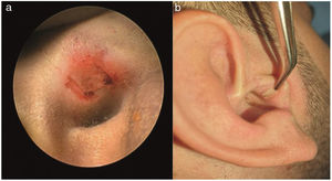 Fotografias mostra (a) uma incisão de enxerto modificada em U para preservar a borda da cartilagem tragal; (b) aparência da incisão do enxerto secundário cicatrizado no sexto mês após a cirurgia.