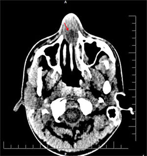 Imagem de tomografia computadorizada (TC) axial sem contraste mostra edema do septo nasal com coleção líquida hipodensa (seta vermelha).