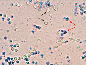 Imagem microscópica de amostras de pus (coloração com azul de metileno, aumento de 10x) drenadas do abscesso do septo nasal. Cistos de Entamoeba histolytica não corados (setas pretas) e leucócitos corados (setas vermelhas) são vistos claramente.