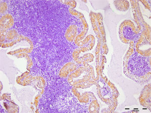 Coloração de Syndecan‐1 no tumor de Warthin (barra de escala representa 0,1mm).