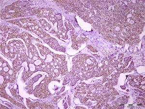 Imunorreatividade para syndecan‐1 foi encontrada no estroma e nas células tumorais do carcinoma adenoide cístico (barra de escala representa 0,2mm).