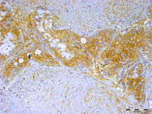 A imunocoloração para syndecan‐1 foi observada em células tumorais e estromais, mas não em células de mucosa de carcinoma mucoepidermoide (barra de escala representa 0,1mm).